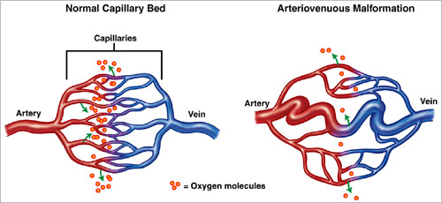 avm