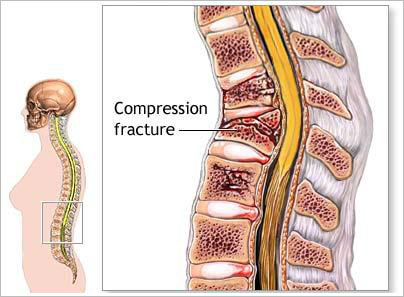 compression fracture