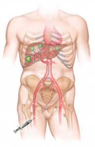 chemoembolization