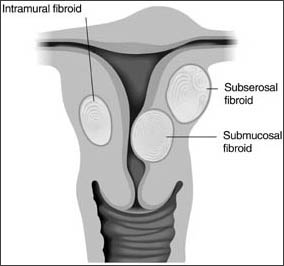 uterine fibroid treatment in Memphis - hysterectomy alternative - MVC