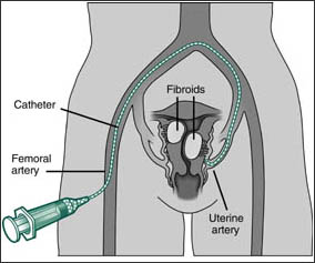uterine fibroid treatment in Memphis