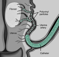 uterine fibroids illustration