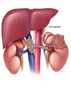 inferiorvenacava