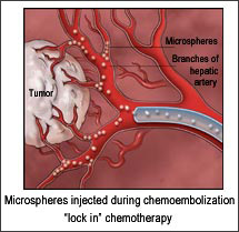 chemoembolization