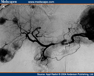 chemoembolization