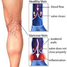 venas varicosas - Memphis vasculares