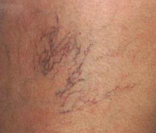 spider vein treatment in Memphis
