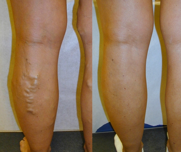 Image of varicose veins before and after treatment at MVC.