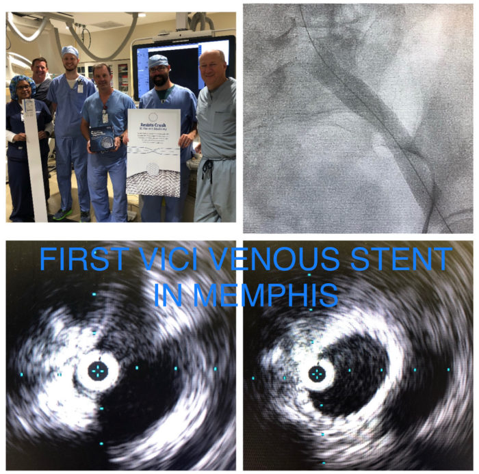 Image of first Memphis physician using FDA-approved stent.
