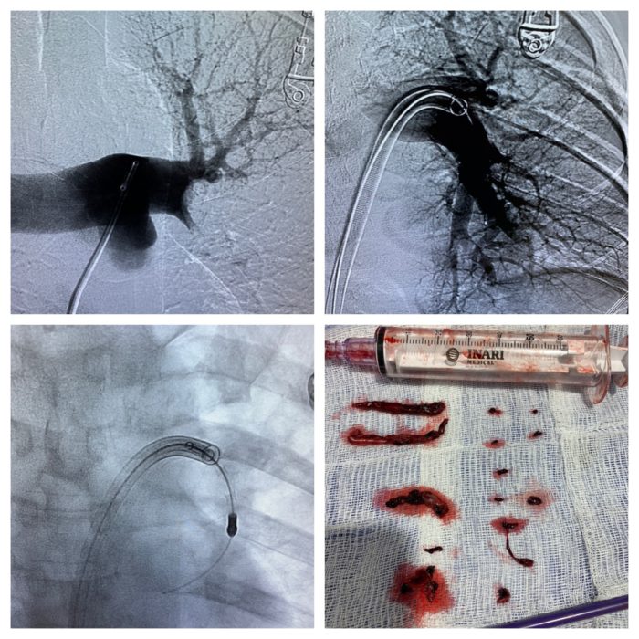 Images of treating a pulmonary embolism at the source.