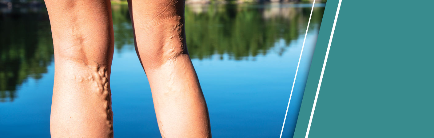 Image of someone standing beside a lake with varivose veins.