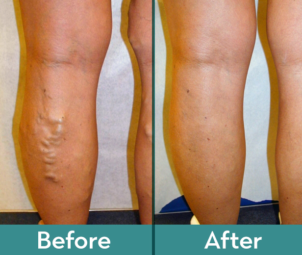varicose vein treatment memphis