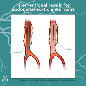 Image of adnominal aortic aneurysm repair