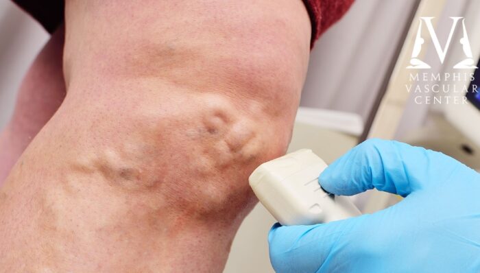 Image of tool being used to help treat varicose vein.
