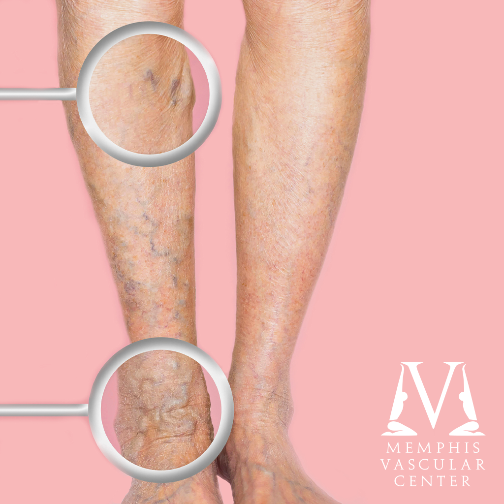 Laser Treatment for Varicose Veins Memphis Vascular Center