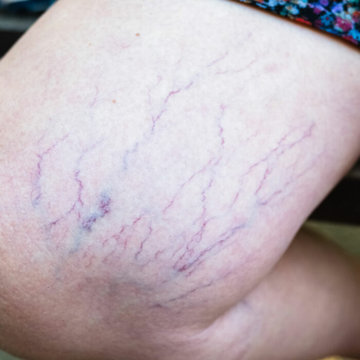 Spider Veins