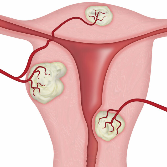 Uterine Fibroid Illustration