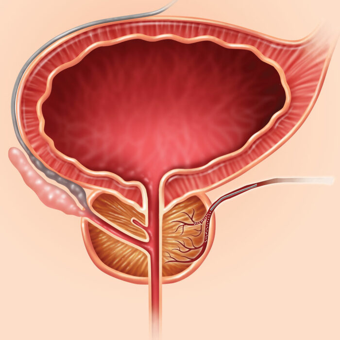 Prostate Illustration