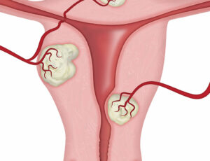 Uterine Fibroid Illustration