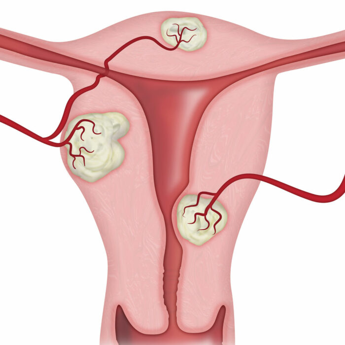 Uterine Fibroid Illustration