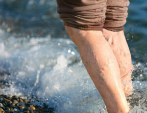 Varicose Veins DVT
