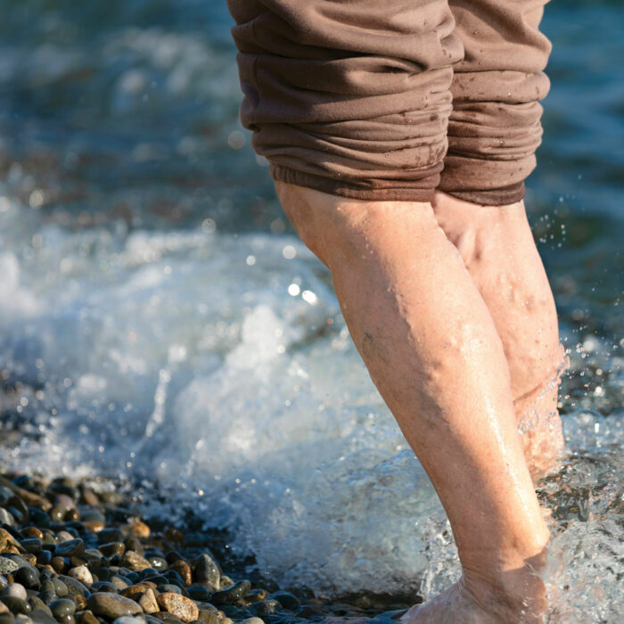 Varicose Veins DVT