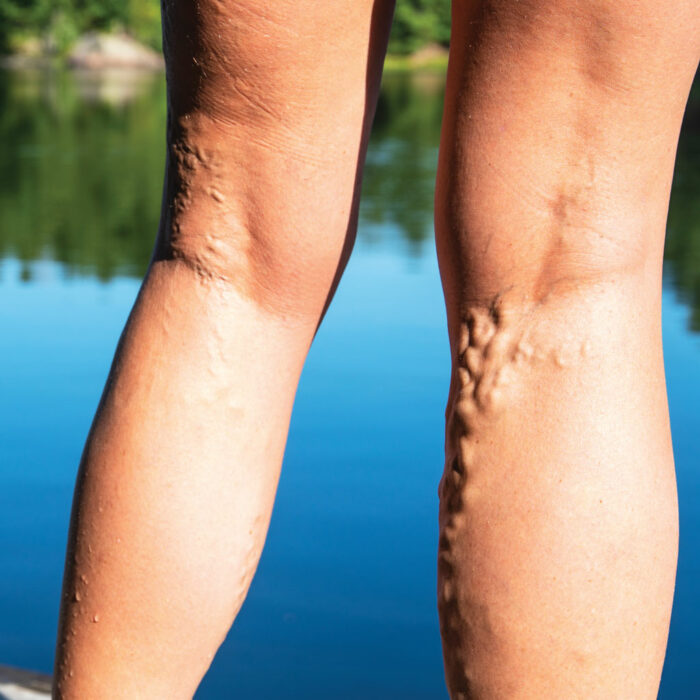 Varicose Veins