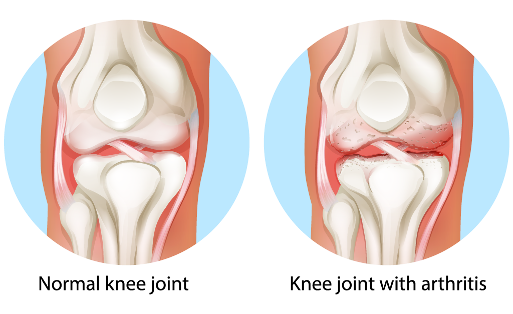 Knee Arthritis Relief - Tennessee