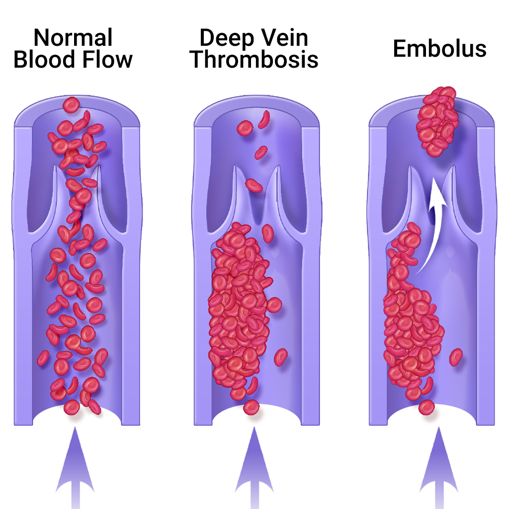 Deep Vein Thrombosis treatment - TN
