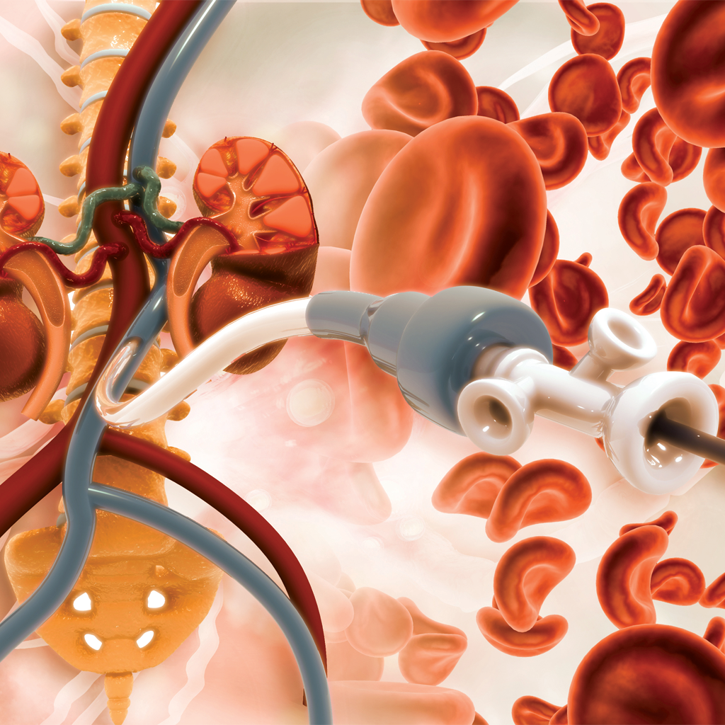 IVC Filter Placement/Removal - Memphis