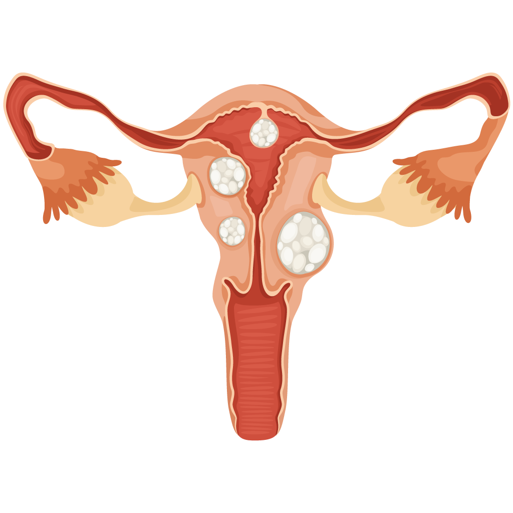 Uterine Fibroid Embolization - Memphis