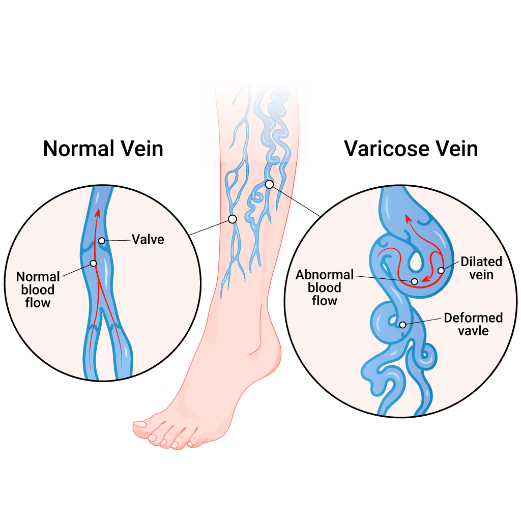 Varicose Veins treatment - Memphis