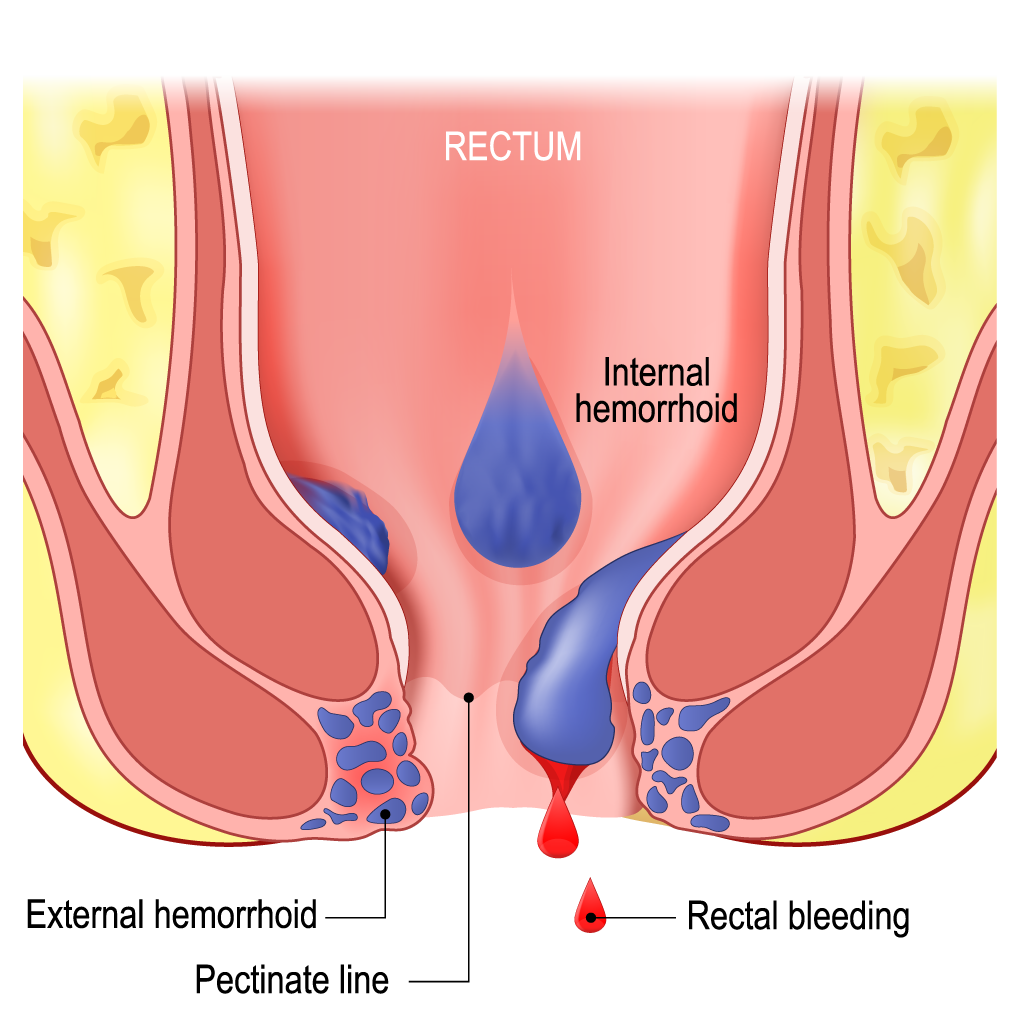 Chronic Hemorrhoid Treatment
