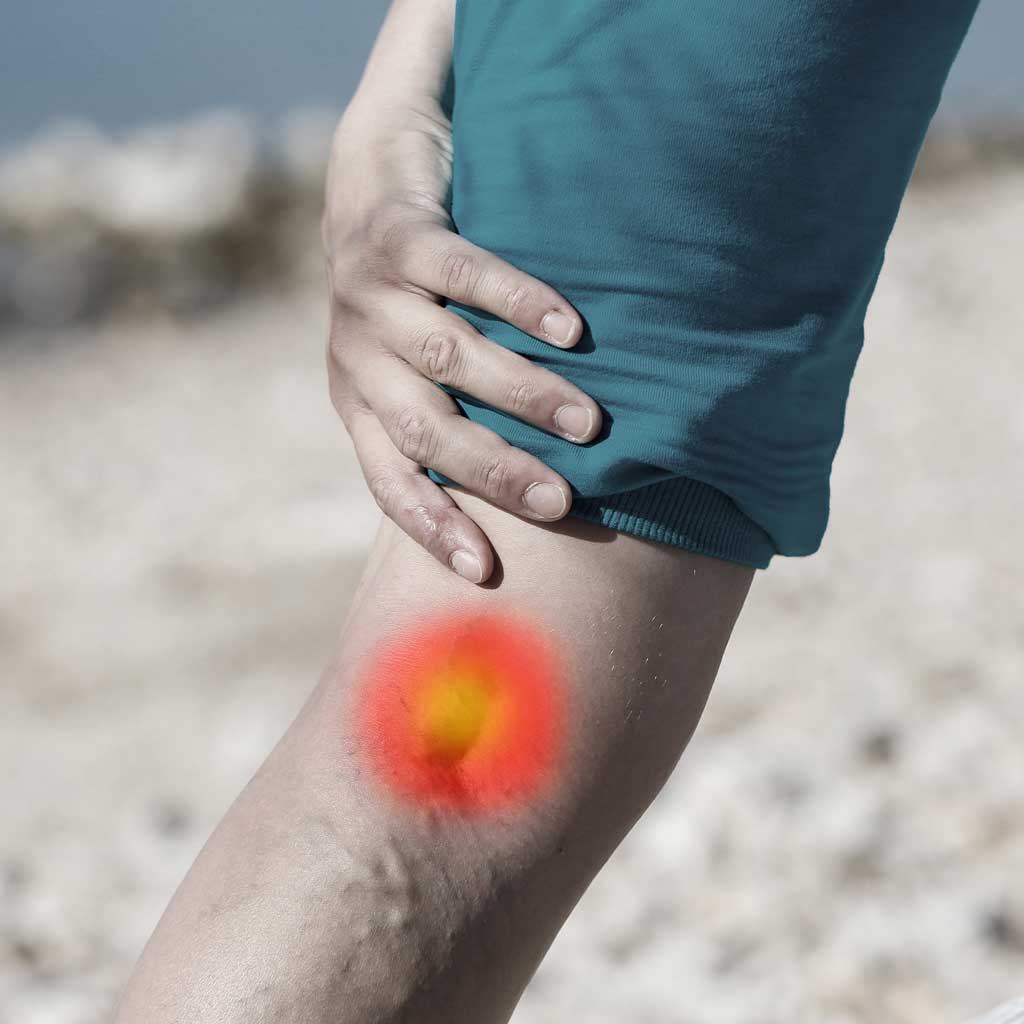 Leg Vein Pain