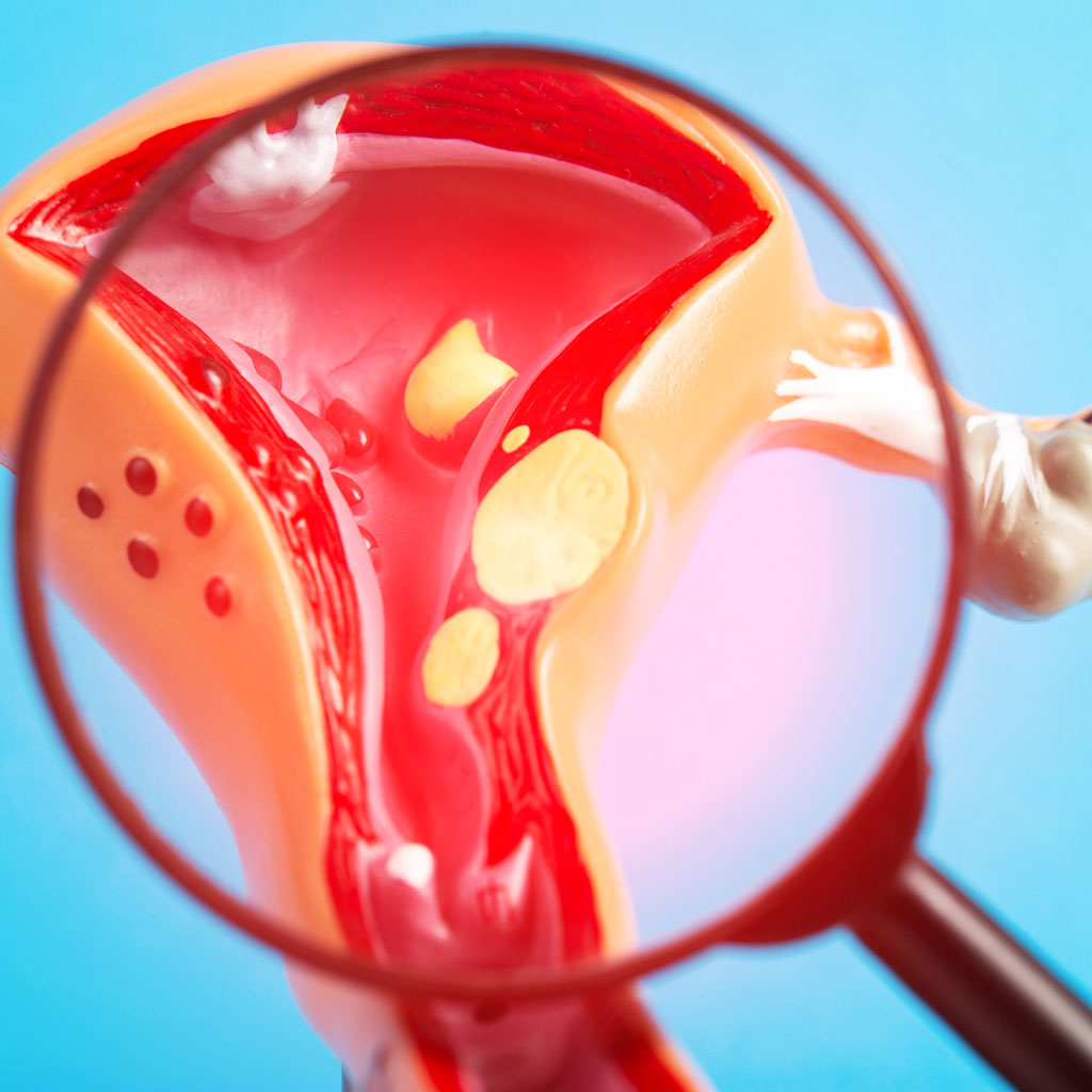 Uterine Fibroids Affect Fertility Model