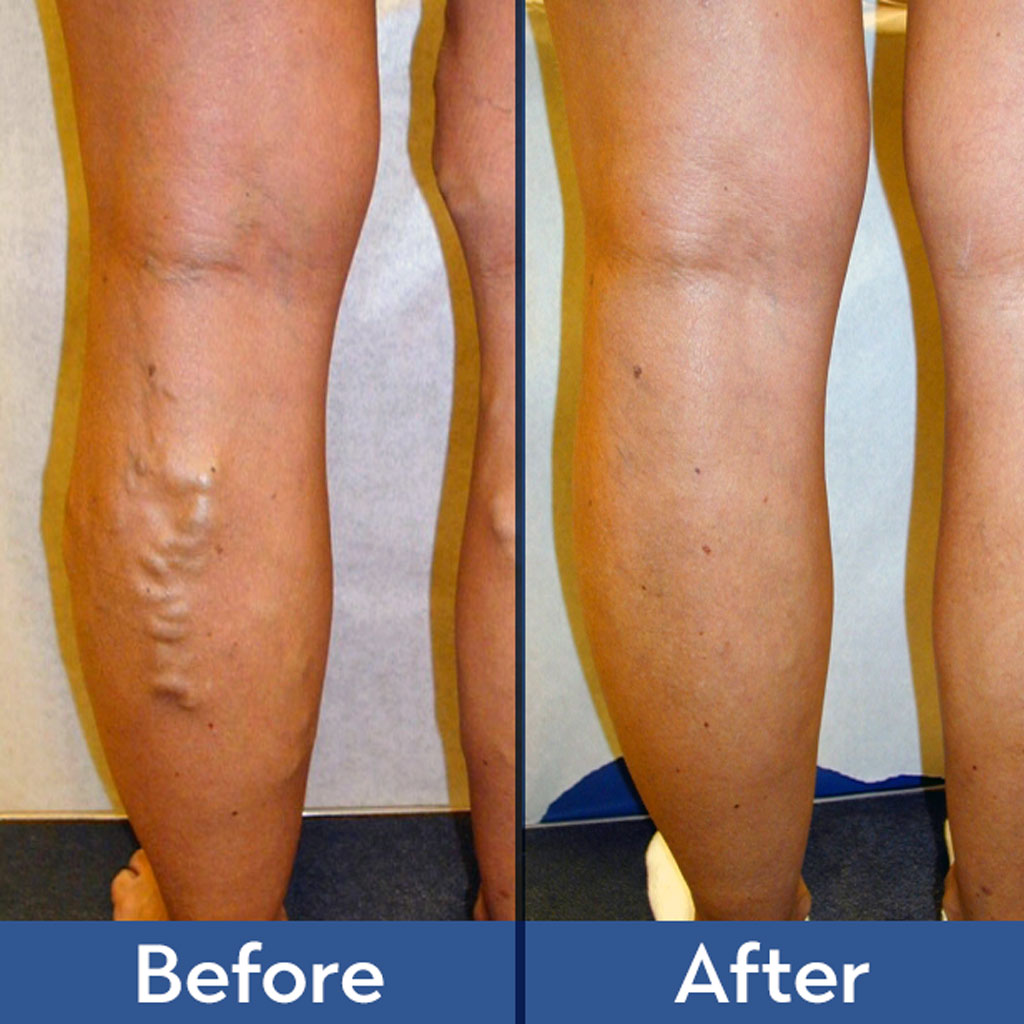 Varicose Veins Before and After