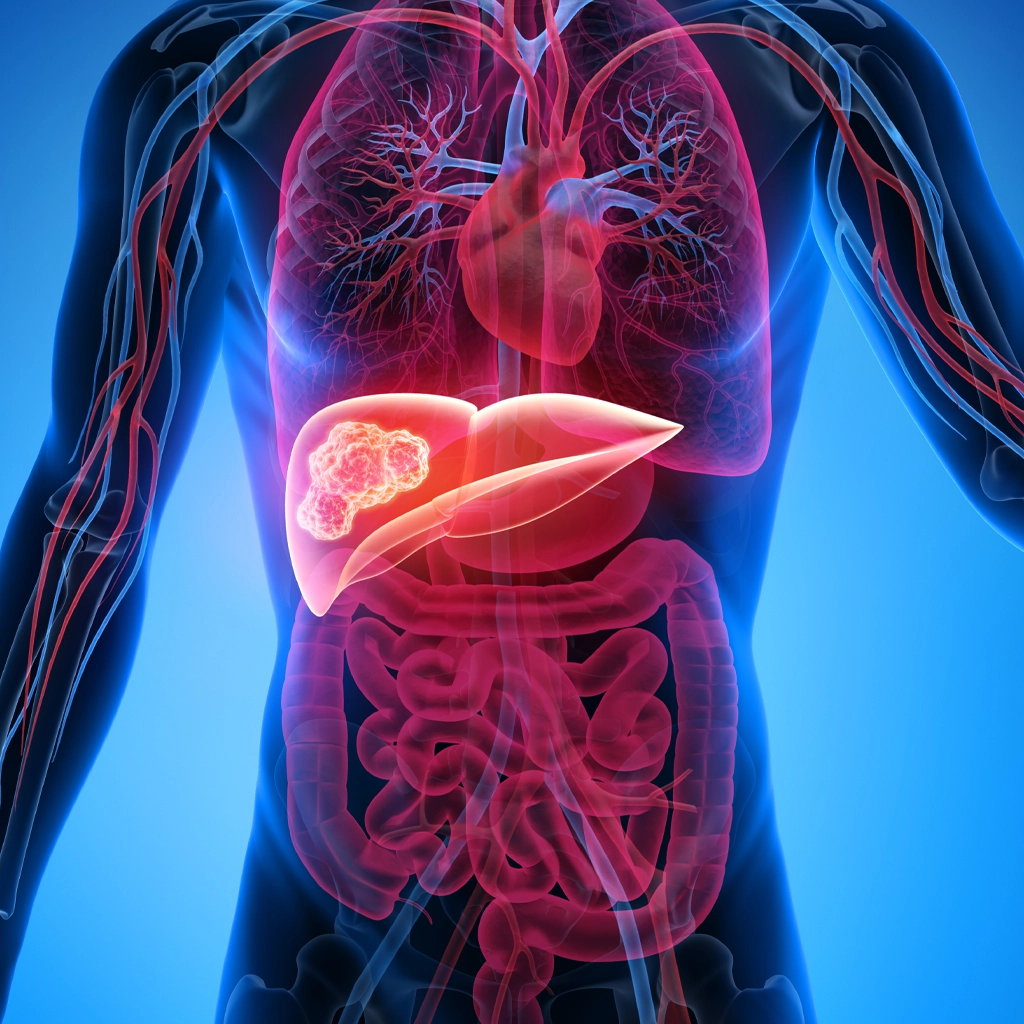 How Y90 helps protect healthy tissue