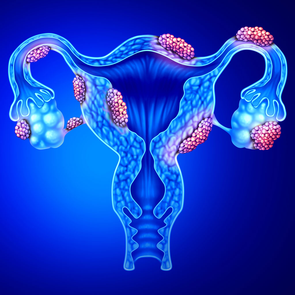 Hysterectomy Side Effects Uterus Illustration with Fibroids
