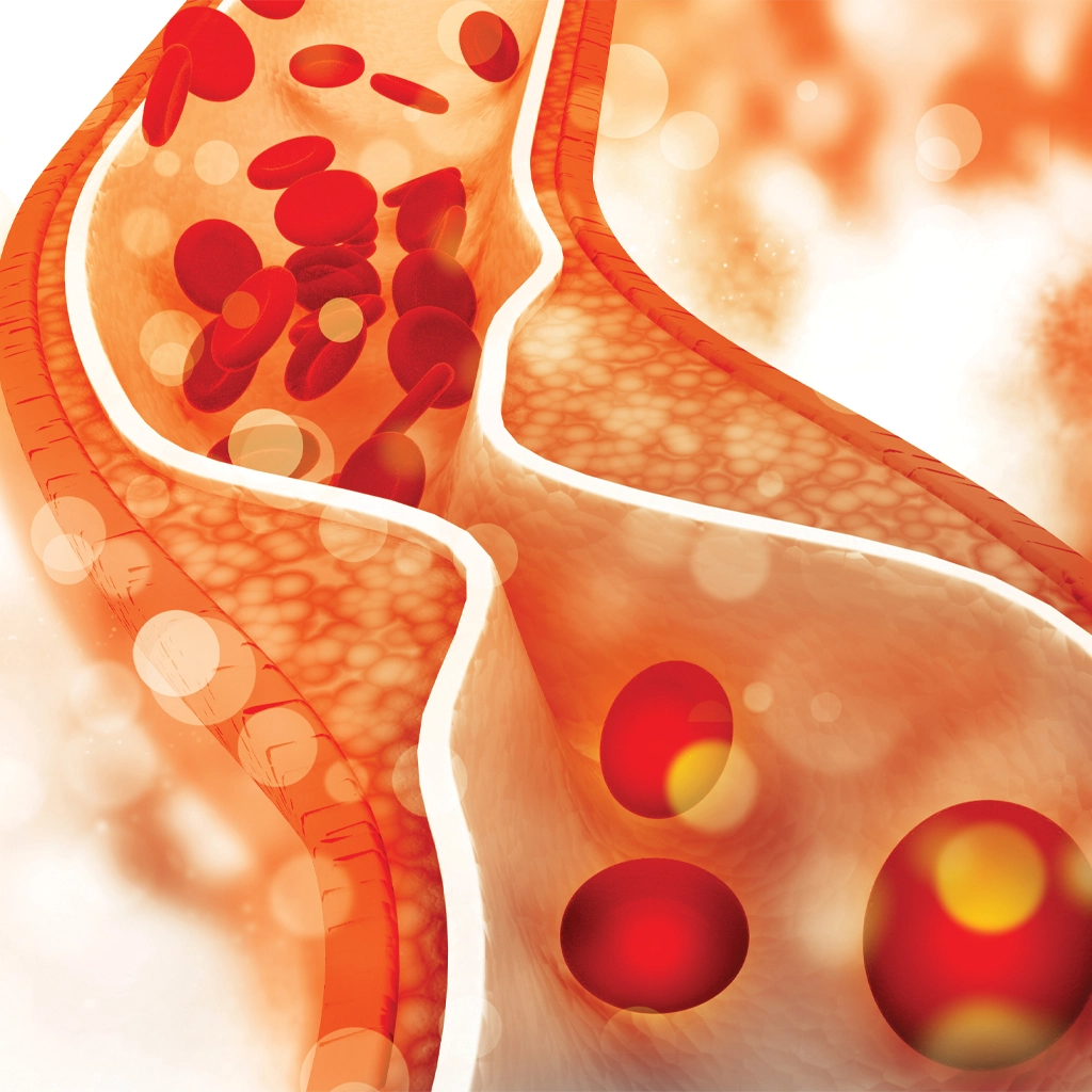Can Peripheral Artery Disease Lead to Amputation?